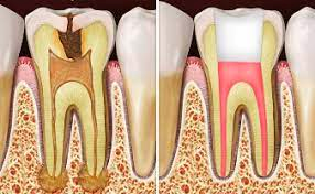 Root canal treatment
